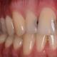 Acute caries - when there is bloom in the mouth, but no smell